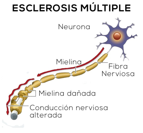 mielina dañada en sistema nervioso – esclerosis múltiple ATEM Tenerife